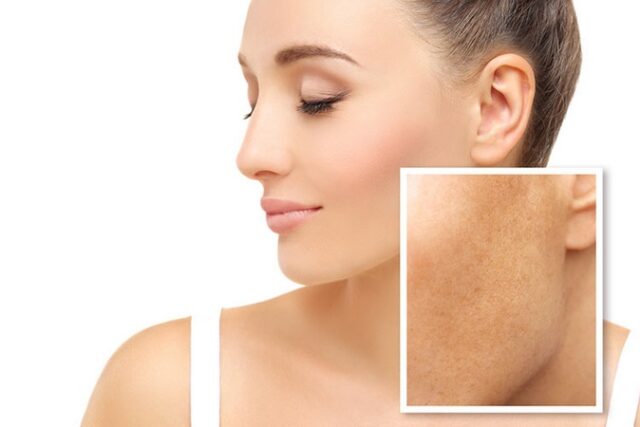 Des astuces naturelles pour faire disparaitre les taches brunes ou les taches de vieillissement sur votre peau