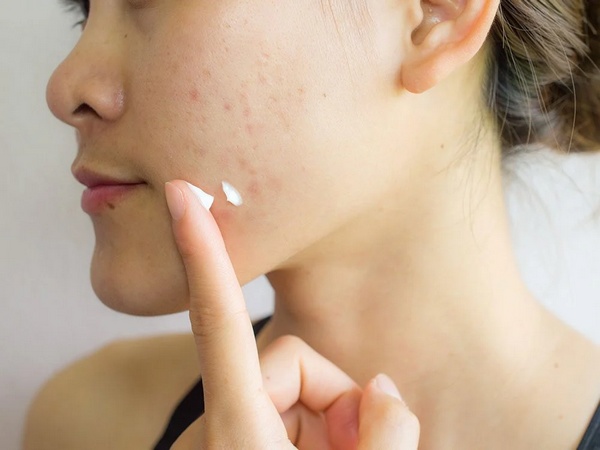 Traitement naturel pour éliminer les cicatrices d’acné