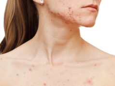 5 conseils efficaces pour éliminer les boutons sur le décolleté