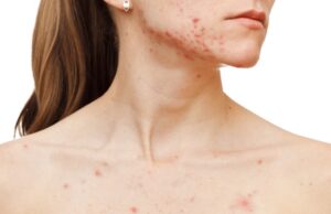 5 conseils efficaces pour éliminer les boutons sur le décolleté 5 conseils efficaces pour éliminer les boutons sur le décolleté