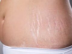 Vergetures : deux soins maison pour les atténuer efficacement